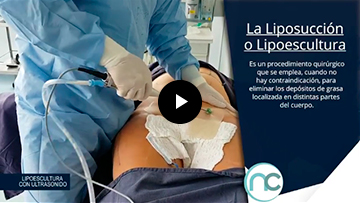 Liposuccion lipoescultura