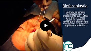 Blefaroplastia Blefaroplastia