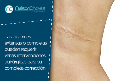 Corrige esa Cicatriz y Mejora tu Apariencia con una Cirugía Plástica en Colombia Cicatriz en la espalda de una mujer para corregir con cirugía plástica en Colombia
