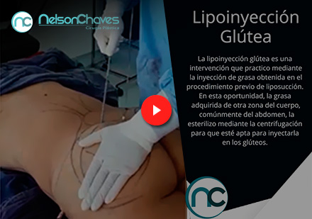 Lipoinyeccin Gltea por un Cirujano Plstico en Colombia