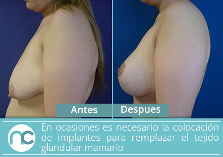 Mujer antes y despus de una mamopexia