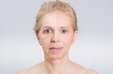 Mujer antes y despus de aplicacin de Toxina Botulnica por un cirujano plstico en bogot