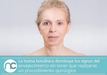 Mujer antes y despus de aplicacin de Toxina Botulnica por un cirujano plstico en bogot