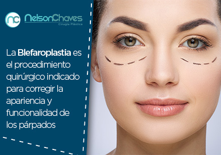 Mujer antes de una ciruga plstica de blefaroplastia en Colombia 