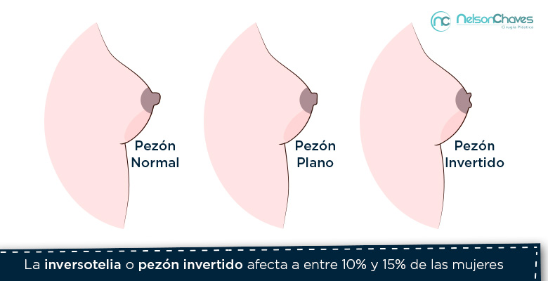 Diferencias entre pezón normal, plano e invertido con un cirujano plástico en Bogotá 