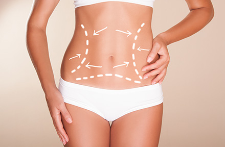 Abdomen definido tras una liposuccin en Bogot 