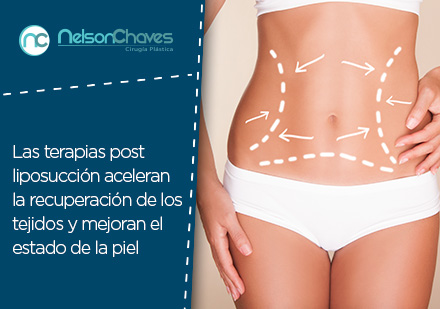 Abdomen definido tras una liposuccin en Bogot 