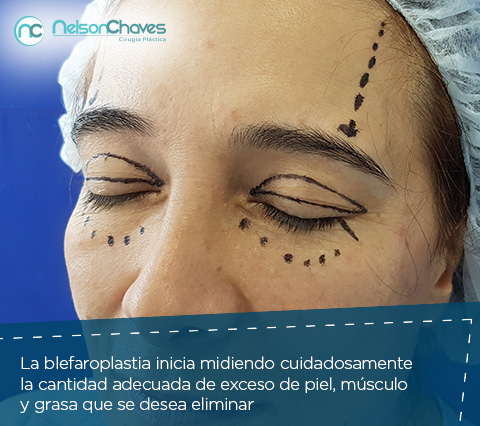 Blefaroplastia en Bogot en mujer de mirada cansada 