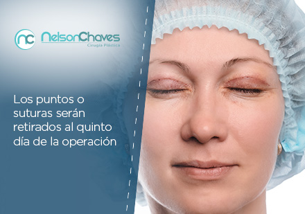 Corrige la Línea de tu Párpado con una Blefaroplastia en Bogotá Blefaroplastia en Bogotá