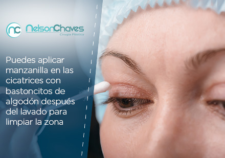 Es de Cuidado Limpiar las Cicatrices de la Blefaroplastia en Bogotá Limpieza de una Blefaroplastia en Bogotá