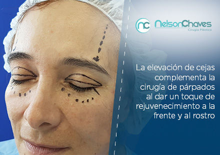 Cirugía de Párpados y Elevación de Cejas