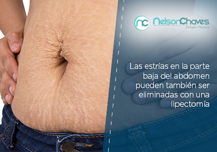 Cirujano Plstico en Bogot Estras en Abdomen 