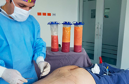 Liposucción en Bogotá por Cirujano Plástico