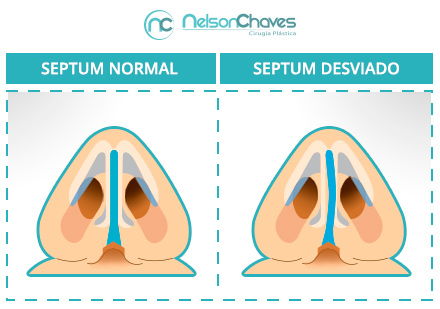 Un Cirujano Plástico de Rinoplastia Repara tu Tabique Desviado Cirujano Plástico de Rinoplastia Septum Desviado y Normal