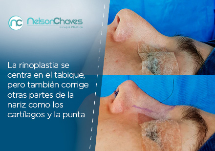 La Rinoplastia la Realiza Únicamente un Cirujano Plástico Especialista Cirujano Plástico de Rinoplastia