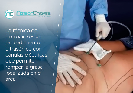 La Liposucción en Bogotá es un Procedimiento Utilizado Para Eliminar la Grasa Localizada Liposucción en Bogota Microaire