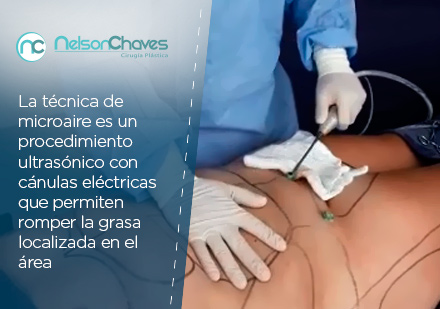 Liposuccin en Bogota Microaire