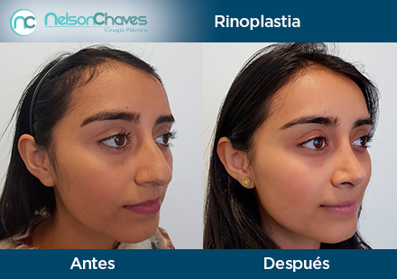 Antes y Después de una Cirugía Plástica en Colombia