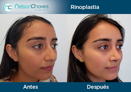 Antes y Despus de una Ciruga Plstica en Colombia