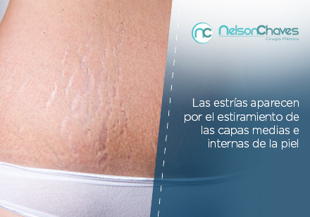 Abdomen con Marcas de Estras