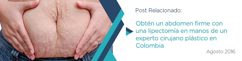 Publicacin Relacionada de Lipectoma Abdominal