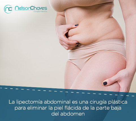 Mujer con Abdomen Flcido que Necesita una Lipectoma Abdominal