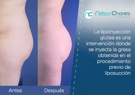 Lipoinyeccin Gltea Despus de una Liposuccin en Bogot 