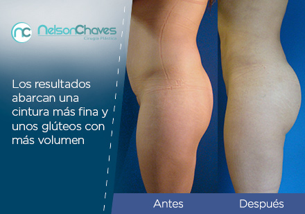 Consigue Resultados Positivos con una Liposucción en Bogotá Antes y Después de la Lipoinyección Glútea