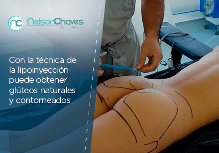 La Liposucción en Bogotá y la Lipoinyección son Procedimientos que se Complementan Marcación de una Lipoinyección Glútea