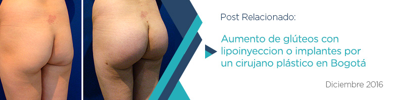¿Quieres un Aumento de Glúteos Después de una Liposucción en Bogotá? Publicación relacionado de Lipoinyección Glútea