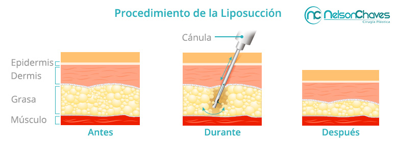 Procedimiento de una Liposuccin