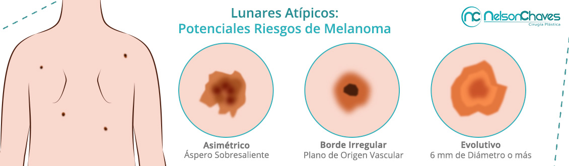 Eliminacin de Lunares