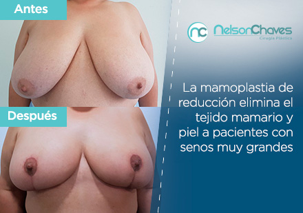 Antes y Despus de una Mamoplastia de Reduccin