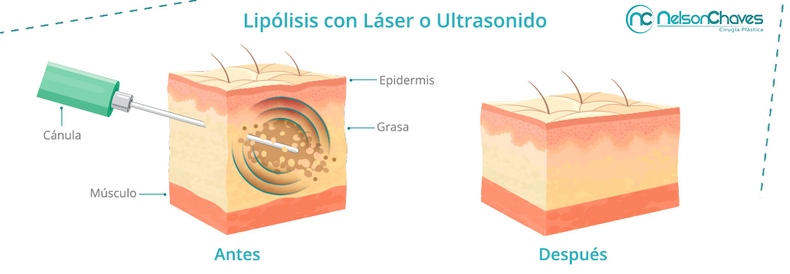 La Lipólisis es una de las Técnicas Quirúrgicas más Solicitadas Lipólisis con Láser o Ultrasonido