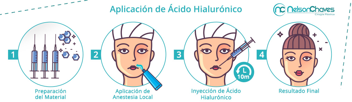 Aplicacin de cido Hialurnico