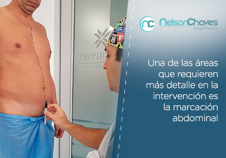 Con una Liposucción Puedes Lograr un Abdomen Marcado Cirujano Plástico Haciendo una Marcación Previa a una Liposucción en Bogotá
