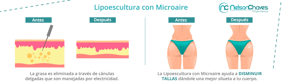 La Lipoescultura con Microaire Elimina la Grasa Localizada Procedimiento de Lipoescultura con Microaire