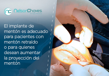 Ciruga con Implantes Faciales