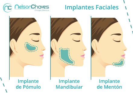 Tipos de Implantes Faciales  