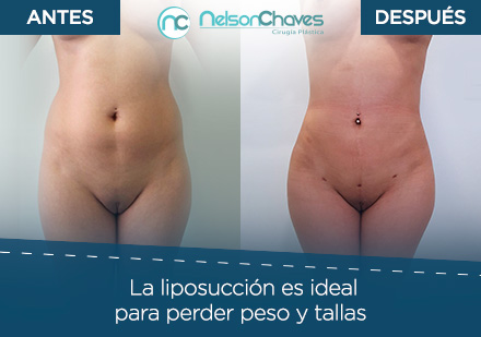 Antes y Despus de una Liposuccin en Bogot