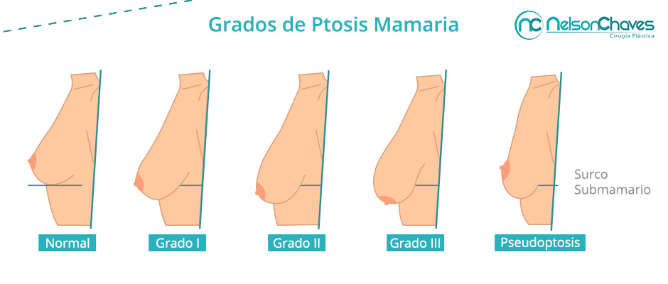 Grados de Ptosis para un Levantamiento de Senos
