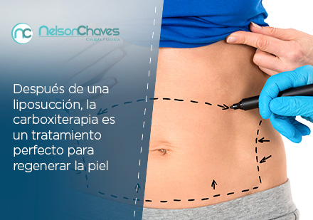 Los Beneficios de la Carboxiterapia Después de la Liposucción se Aprovechan en Otros Lugares del Cuerpo Consulta para una Liposucción