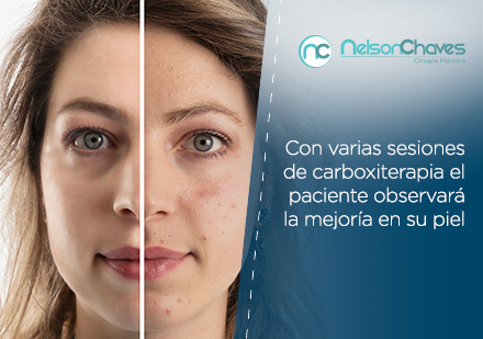 Antes y Despus de una Carboxiterapia facial