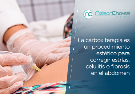 Carboxiterapia Despus de una Liposuccin Realizada por el Dr Nelson Chaves