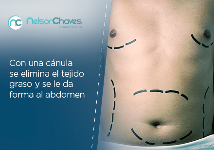 Hombre en Consulta para Zona de Liposuccin Abdominal