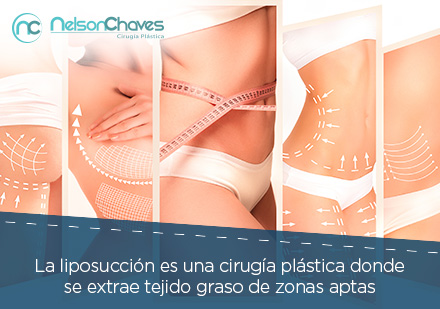 Chica con Diferentes Zonas de Liposuccin Marcadas en su Cuerpo