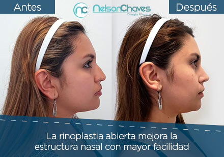 Antes y despus de una Rinoplastia en Paciente