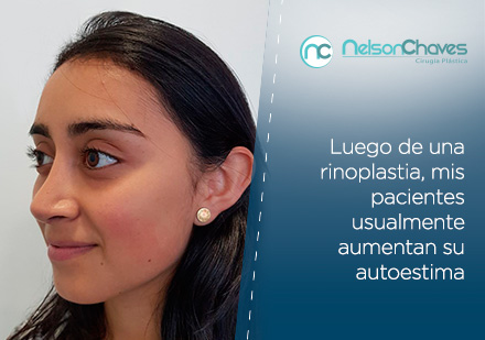 Joven Alegre con Rinoplastia sin Cicatrices Visibles 