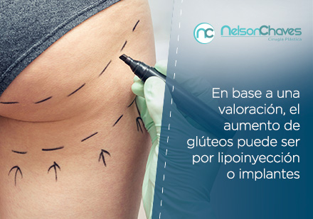 Valoracin Para una Liplisis y Aumento de Glteos con Lipoinyeccin