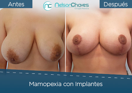 Cirugía de Senos Mamopexia con Implantes